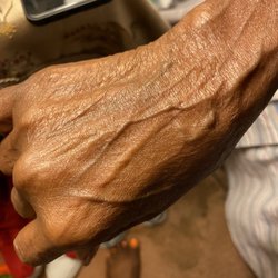 Barnes Jewish Hospital - BJC (main hospital): blown veins