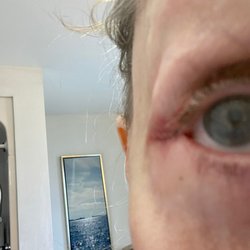 Eye Face Institute - Another picture of the scar Dr gill has created