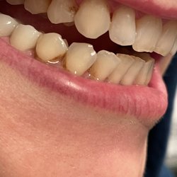 The Foleck Center - My teeth after my year long, 5 figure, treatment plan. Thanks Foleck!