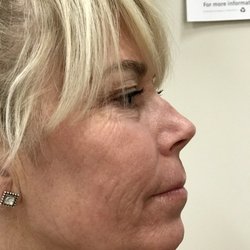 Bridget Briggs, MD - The Briggs Institute of Epigenetic Medicine - After the fractional CO2 laser - Part 3