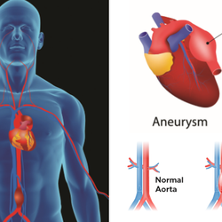 Ioannis Loumiotis, MD - Aortic Aneurysm Program_RWJ Barnabas Health