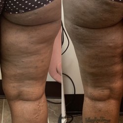 Evolve Body & Beauty - 1 session of cellulite reduction.
