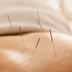 Oliver Pain Relief and Rehab - Ask about how Acupuncture can help with your physical needs.