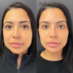 Yunik Aesthetics Medspa - A contoured, refreshed, and balanced look for this beautiful babe! Treatment: Cheek, Jawline, Lip and Chin Filler.