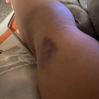 MRS Massage Relief Station - Bruise - Massage Near Me - Fresno, California