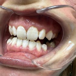 MiraMar Family Dental - Patient showing her teeth