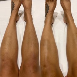 Leg sugaring