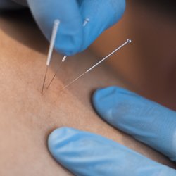 No More Knots- Greenslopes - Dry Needling at NMK