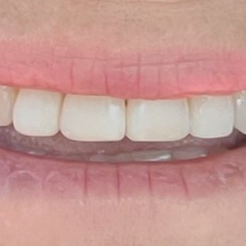 Lake Ridge Dental Associates - my old front teeth made new again without crowns or veneers - Periodontists Near Me - Woodbridge, Virginia Lake Ridge Dental Associates - my old front teeth made new again without crowns or veneers - Periodontists Near Me - Woodbridge, Virginia