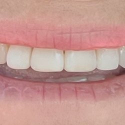 Lake Ridge Dental Associates - My old front teeth made new again without crowns or veneers