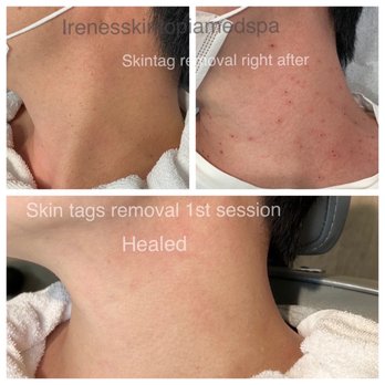 Irene's Skintopia - SkinTag removal / right after / healed - Skin Care Near Me - Los Angeles, California Irene's Skintopia - SkinTag removal / right after / healed - Skin Care Near Me - Los Angeles, California