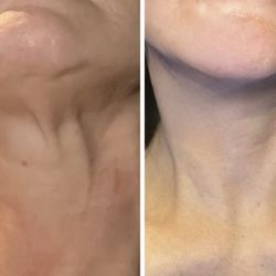 Plastic Surgery Services of Fredericksburg - Before/After