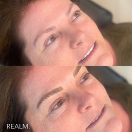 Before and after. - Two close-up images of a woman's face are displayed, focusing on her eyebrows. The top image shows her natural eyebrows, while the bottom image shows her eyebrows after microblading, appearing more defined and shaped. The woman has light skin, brown hair, and is lying down with her eyes open. The images emphasize the cosmetic enhancement of eyebrow microblading, with the second photo including a watermark reading 'REALM.'