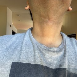 Sauler Institute - This is what the scar looked like before I saw Taylor!