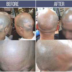 KIKO HAIR Studio - Scalp Micro-pigmentation Alopecia Areata