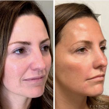 Frisch Aesthetics - Variety of medical aesthetics can help "refresh" - Medical Spas Near Me - Diamond, Illinois Frisch Aesthetics - Variety of medical aesthetics can help "refresh" - Medical Spas Near Me - Diamond, Illinois