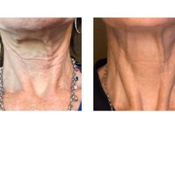 Evergreen Body Contouring - RF Microneedling for Skin Tightening and rejuvenation