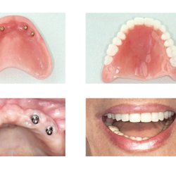 Emergency Denture Services - Implant placement on Friday only come in for free consultation and free Denture repair with purchase of new Dentures