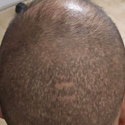 Hair Restoration Specialists of Atlanta