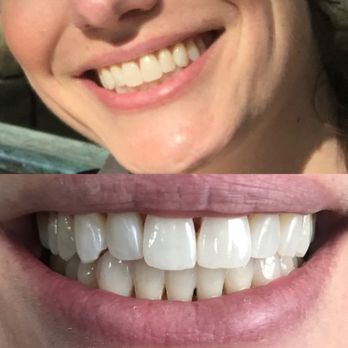 Glintr Mobile Teeth Whitening - Teeth Whitening Near Me Glintr Mobile Teeth Whitening - Teeth Whitening Near Me