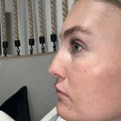 Daniel J Leeman, MD - My nose after surgery with a large bump