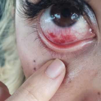 Lavender Falls Face And Body Spa - Chemical burns from eyelash extensions here - Skin Care Near Me - San Antonio, Texas Lavender Falls Face And Body Spa - Chemical burns from eyelash extensions here - Skin Care Near Me - San Antonio, Texas