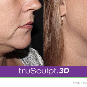 Wellness Diagnostics & Medispa - Under Chin 4 months Later, 3 treatments with TruSculpt 3D - Medical Spas Near Me - Temecula, California