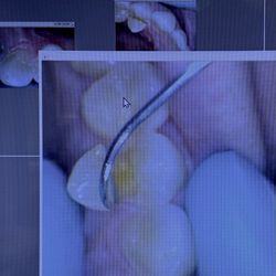 Skyline Dental - Broken tooth