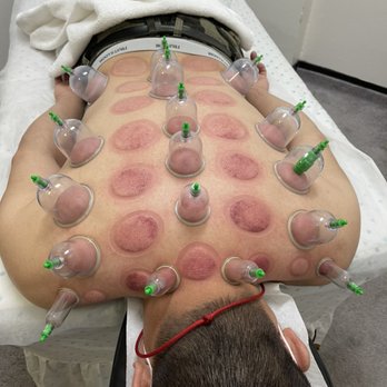 Massage Therapy - Cupping Therapy - Massage Therapy Near Me - Salinas, California Massage Therapy - Cupping Therapy - Massage Therapy Near Me - Salinas, California