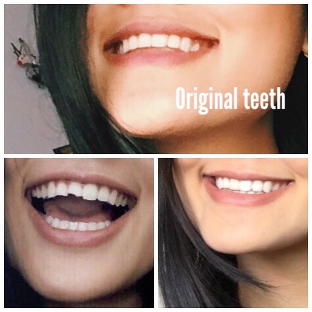 Peter J Lee, DDS - He did a really great job at bonding my teeth to match my original teeth! - Cosmetic Dentists Near Me - Irvine, California Peter J Lee, DDS - He did a really great job at bonding my teeth to match my original teeth! - Cosmetic Dentists Near Me - Irvine, California