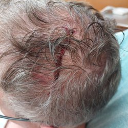 Mercy Medical Center - My head wound after the car accident