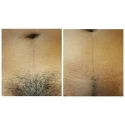 Glow Skin Haus - Before and after Brazilian Wax...