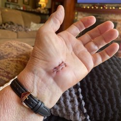 Sports Medicine Oregon - Left hand after wrap is removed