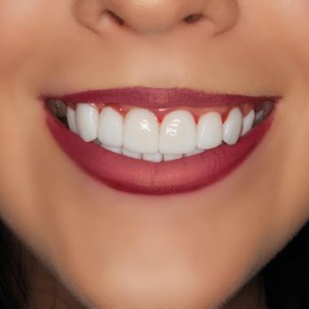 Creating Smiles Dental - After - Frontal View - General Dentistry Near Me - St. Petersburg, Florida Creating Smiles Dental - After - Frontal View - General Dentistry Near Me - St. Petersburg, Florida