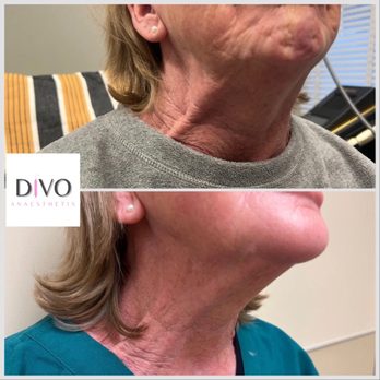 Divo Anaesthetix - Dysport Nefertiti neck lift - Medical Spas Near Me - Aspen, Colorado Divo Anaesthetix - Dysport Nefertiti neck lift - Medical Spas Near Me - Aspen, Colorado