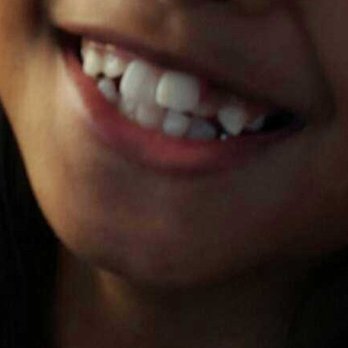 Pristine Orthodontics - She had a cross bite and over bite. Teeth growing in every direction. - Orthodontists Near Me - Mountain View, California
