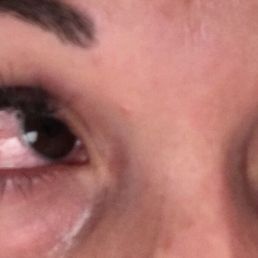 BACTERIAL conjunctivitis (pink eye) BACTERIAL conjunctivitis (pink eye)