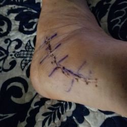 Lonestar Rehabilitation - This is my ankle 4 weeks after surgery for a ruptured perineal tendon.