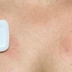 Cardiovascular Institute Of San Diego - skin is extremely sensitive to the scratchy 3M prep tape & adhesive on the leads