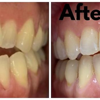 Floss Family Dentistry - Before and after Invisalign treatment for teeth straightening. - General Dentistry Near Me - Morgan Hill, California Floss Family Dentistry - Before and after Invisalign treatment for teeth straightening. - General Dentistry Near Me - Morgan Hill, California