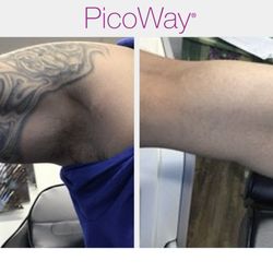 EOS Tattoo Removal