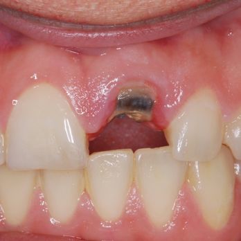 Tracey Dental - Before - General Dentistry Near Me - McKinney, Texas Tracey Dental - Before - General Dentistry Near Me - McKinney, Texas