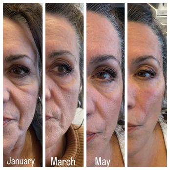 Skinpedia - This is PRF platelet rich fibrin reversing jawling, and helps with skin tightening and rejuvenation - IV Hydration Near Me - San Francisco, California Skinpedia - This is PRF platelet rich fibrin reversing jawling, and helps with skin tightening and rejuvenation - IV Hydration Near Me - San Francisco, California