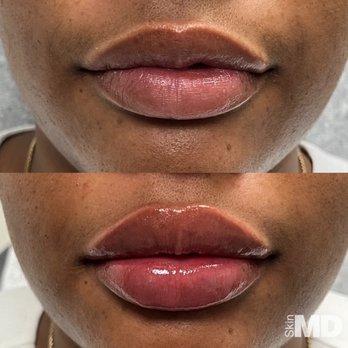 Skin MD - Subtle, natural, & beautifully enhanced. Lip fillers add volume, definition, & symmetry. Results tailored to your unique desires & features. - Laser Hair Removal Near Me - Hanover, Massachusetts Skin MD - Subtle, natural, & beautifully enhanced. Lip fillers add volume, definition, & symmetry. Results tailored to your unique desires & features. - Laser Hair Removal Near Me - Hanover, Massachusetts