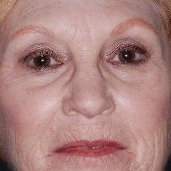 Elite Facial Plastic Surgery - Laser Resurfacing Before