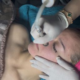 Hydrofacial and microdermoabrasión ‍