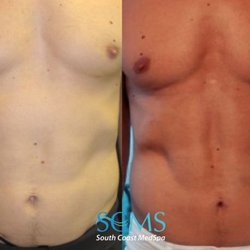 South Coast MedSpa - Morpheus8 Before and After 3 Treatments,  showing amazing reduction in stubborn fat