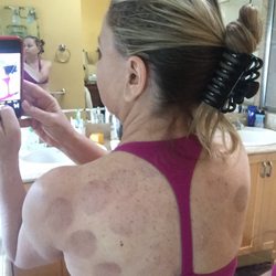 Healing Power Chinese Acupuncture - Cupping