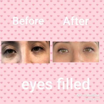 NU-U Med Spa - Take years off your look fill your under eyes - Medical Spas Near Me - Plantation, Florida
