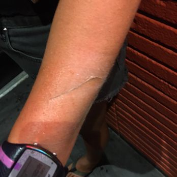 Bar 35 - This is my wife's arm right after that ape of a security guard literally threw us out for no reason. - Bars Near Me - Honolulu, Hawaii Bar 35 - This is my wife's arm right after that ape of a security guard literally threw us out for no reason. - Bars Near Me - Honolulu, Hawaii